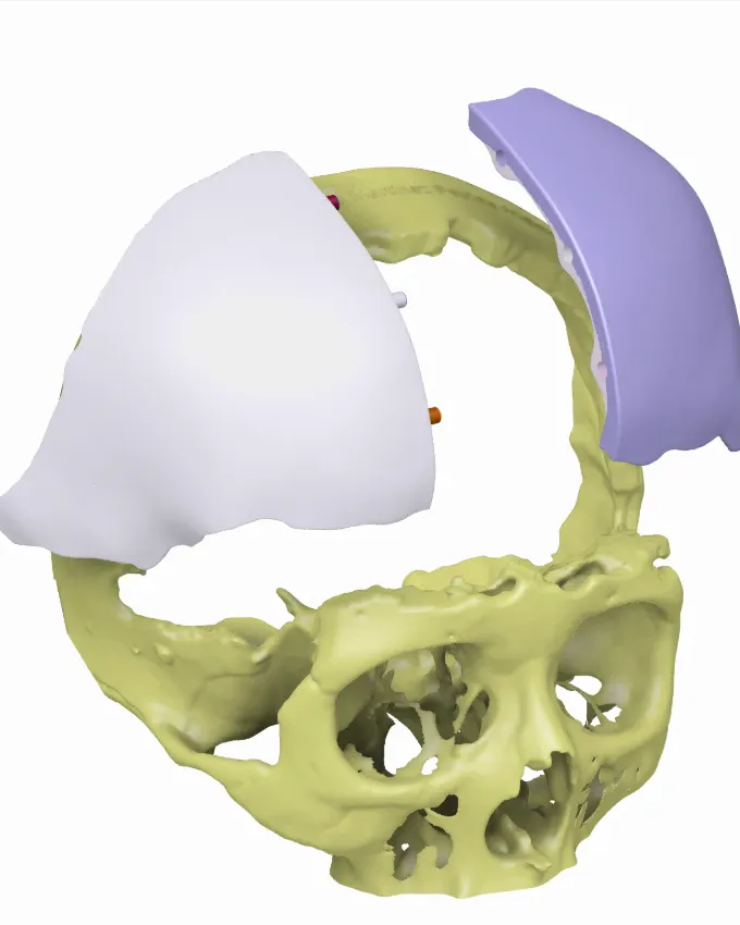 Custom cranial implant